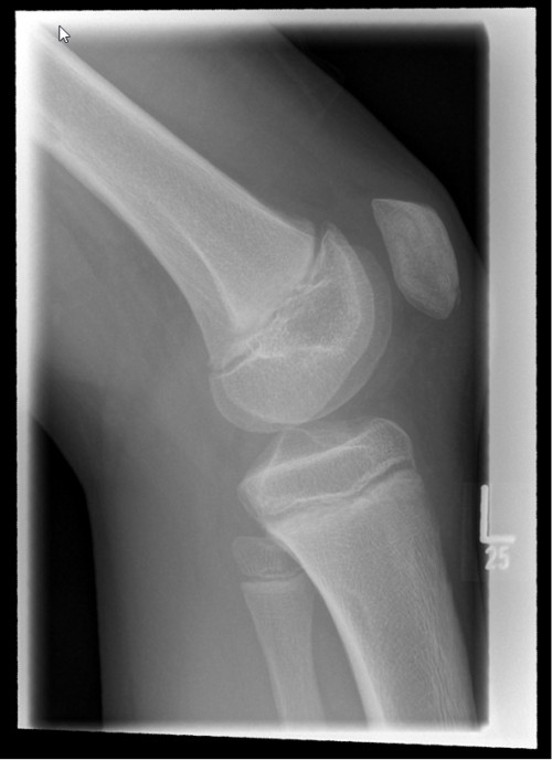 Röntgen 2 Knie links