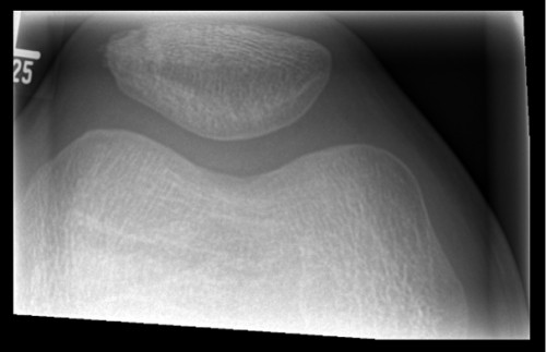 Röntgen 3 Patella links