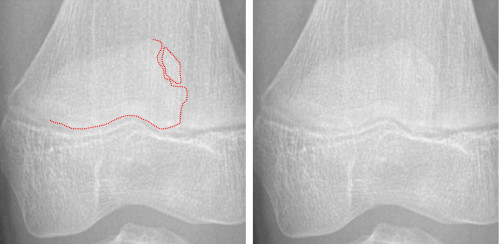 Hinweis auf Patellafraktur