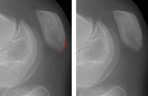 Hinweis auf Patellafraktur