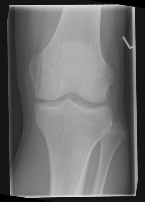 Röntgen Knie a.p.