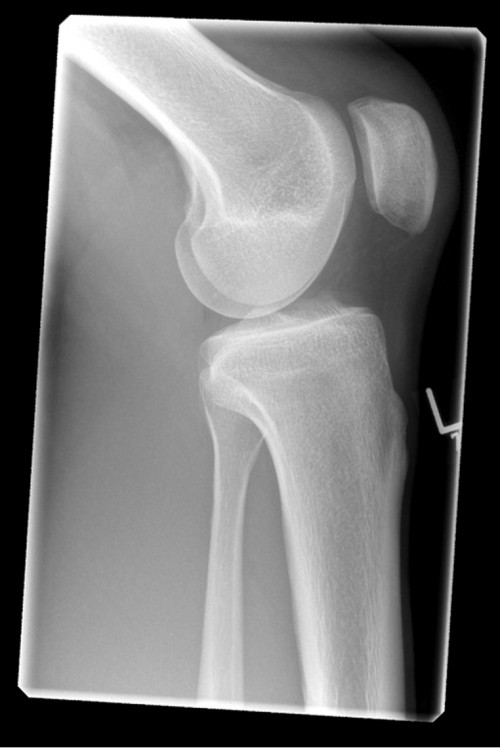 Röntgen Knie seitlich