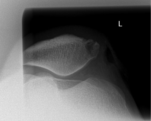 Röntgen Patella tangential