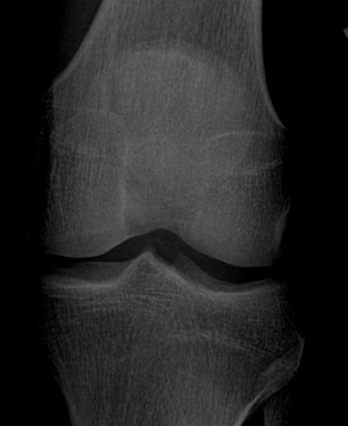 Röntgen Knie a.p. Ausschnitt