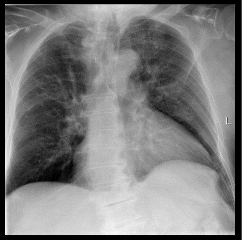 Röntgen Thorax