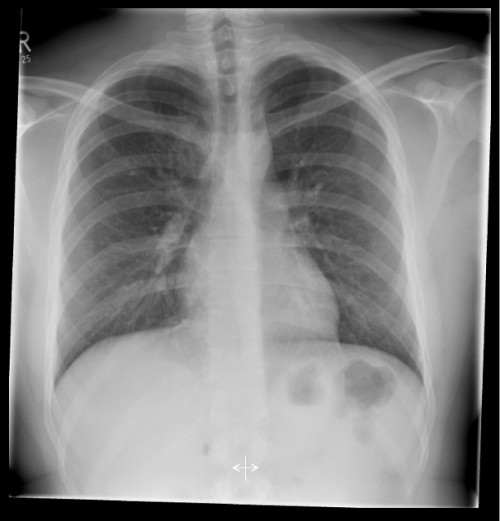 Röntgen Thorax