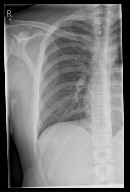 Röntgen Hemithorax rechts a.p.