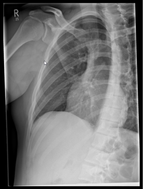 Röntgen Hemithorax rechts seitlich