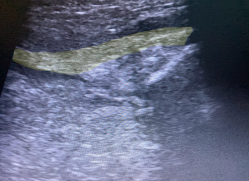 Sonografie linkes Knie suprapatellar
