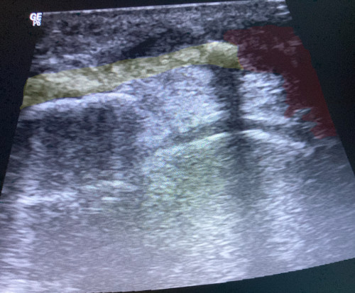 Sonografie linkes Knie infrapatellar