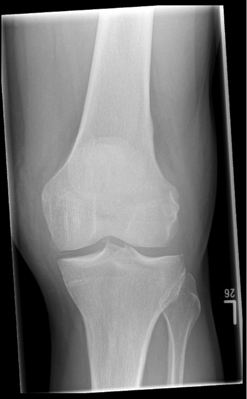 Röntgen Knie links a.p.
