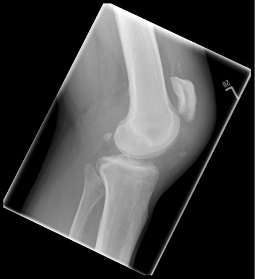 Röntgen Knie links seitlich