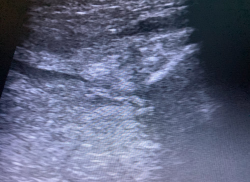 Sonografie linkes Knie 1