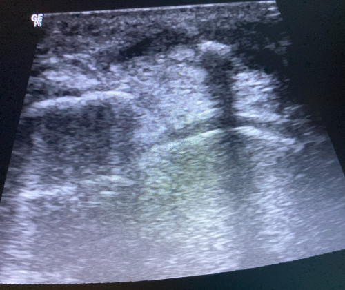 Sonografie linkes Knie 2