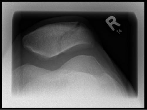 Patella rechts tangential