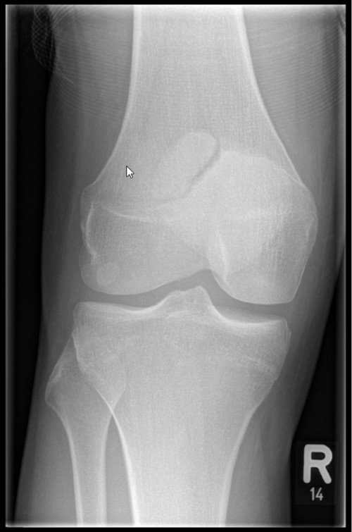 Röntgen Knie rechts 2 Ebenen a.p.