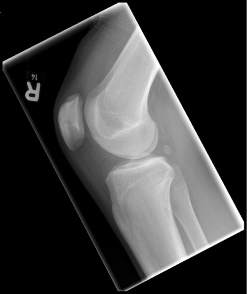 Röntgen Knie rechts 2 Ebenen seitlich