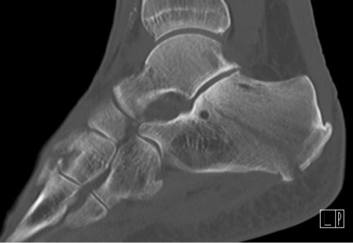CT Calcaneus links sagital