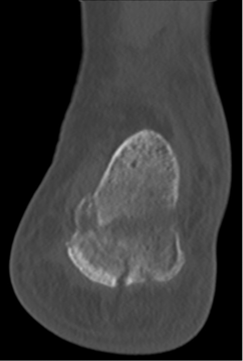 CT Calcaneus links coronal