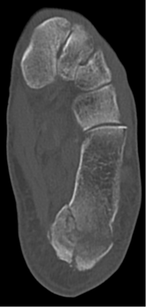 CT Calcaneus links axial
