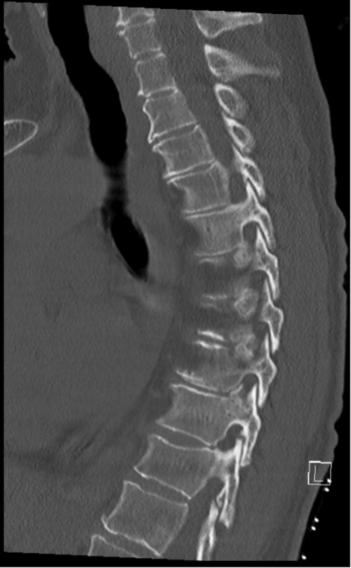 CT BWS sagittal 1