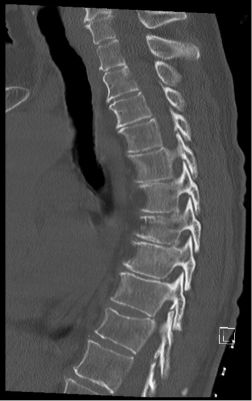 CT BWS sagittal 2