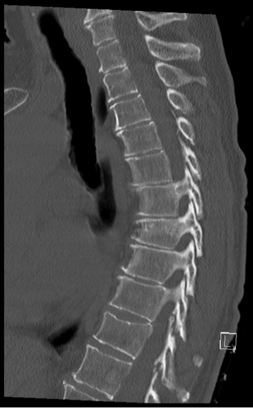 CT BWS sagittal 3