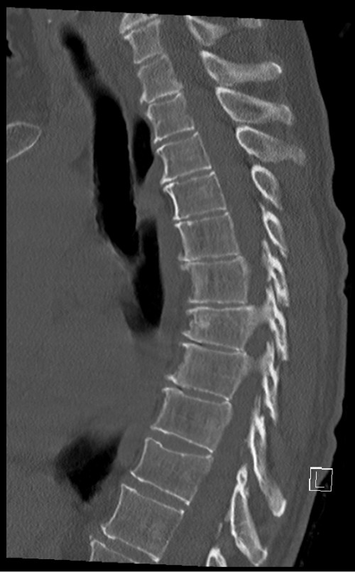 CT BWS sagittal 4