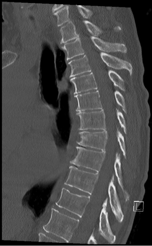 CT BWS sagittal 5