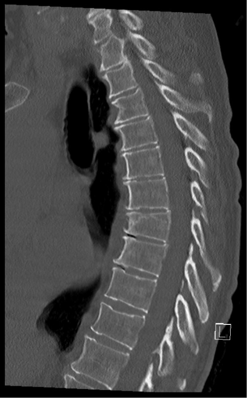 CT BWS sagittal 6