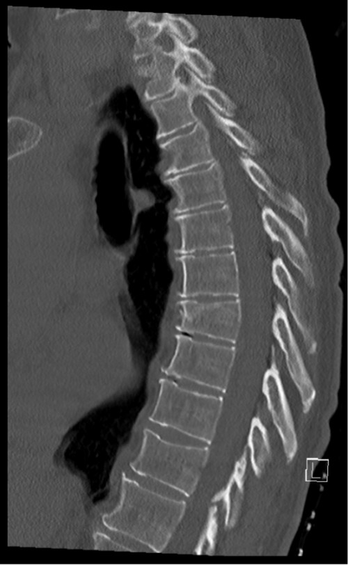 CT BWS sagittal 7