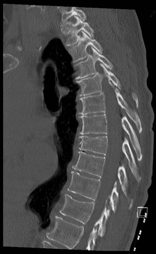 CT BWS sagittal 8