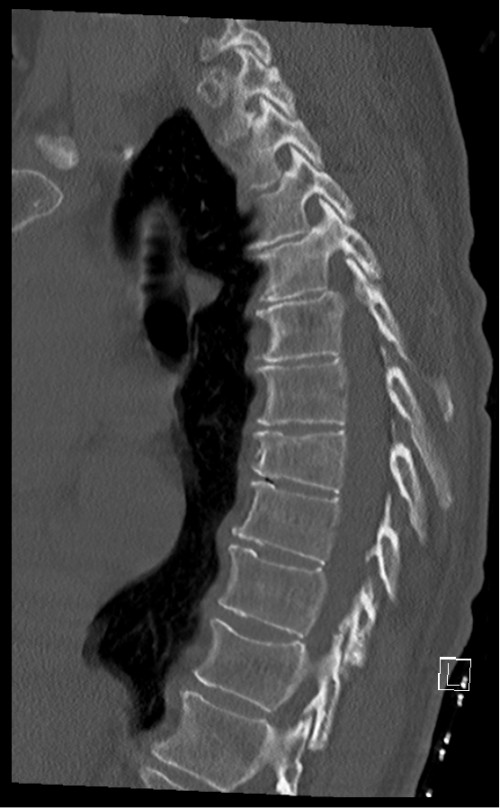 CT BWS sagittal 9