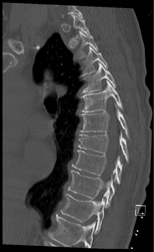 CT BWS sagittal 10