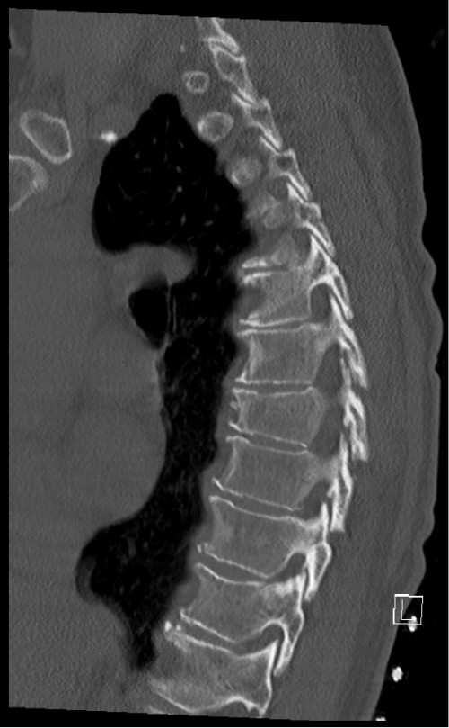 CT BWS sagittal 11