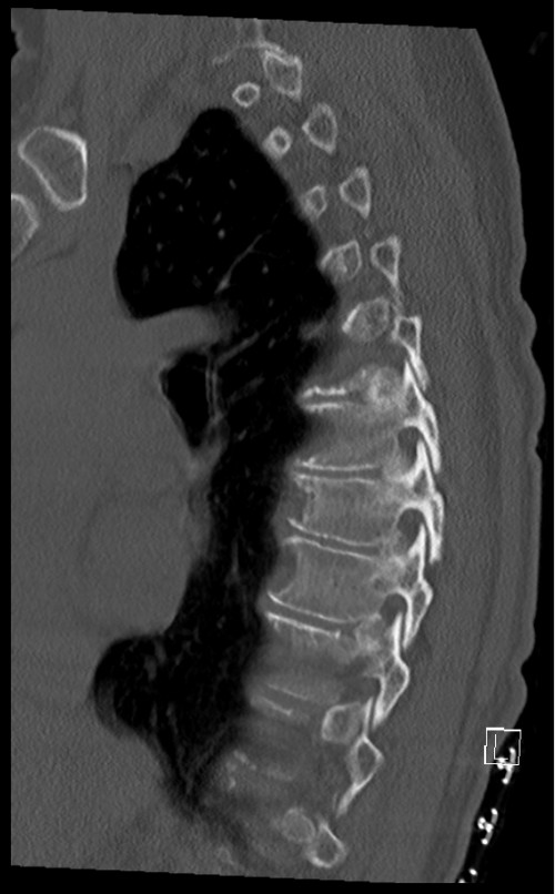 CT BWS sagittal 13
