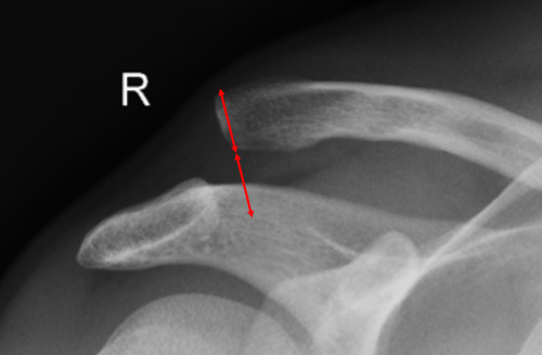 Claviculahochstand um ca. eine Schaftbreite