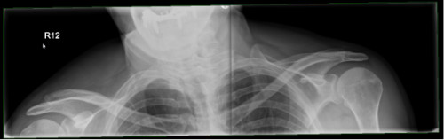 Röntgenaufnahme des oberen Thorax mit Abbildung beider Claviculae und AC-Gelenke
