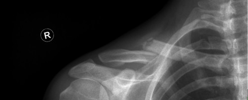 Röntgen Clavicula rechts p.a.