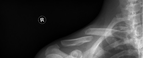 Röntgen Clavicula rechts tangential
