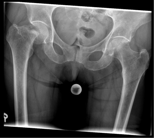 Röntgen Becken tief