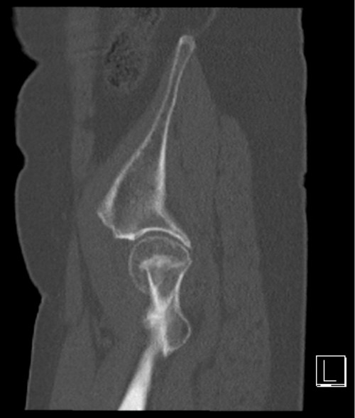 CT becken sagittal