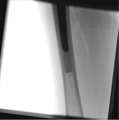 Intraoperative Durchleuchtung