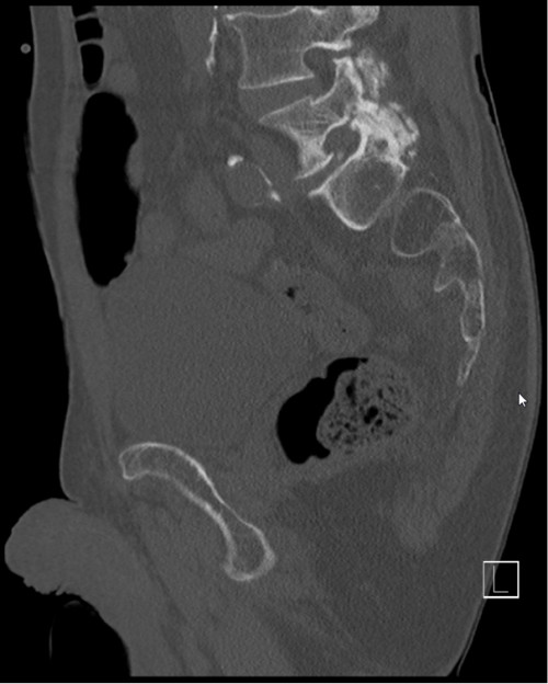 CT Becken sagittal