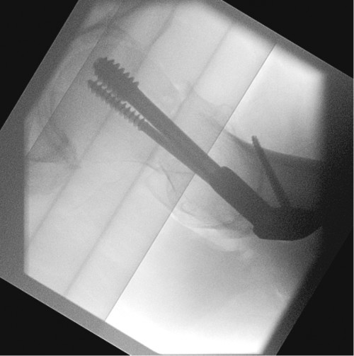 Intraoperative Durchleuchtung