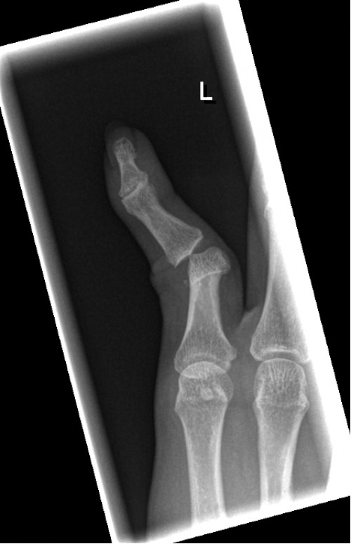 Röntgen Finger D5 links