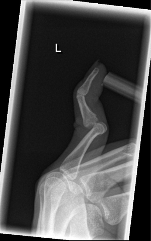 Röntgen Finger D5 links