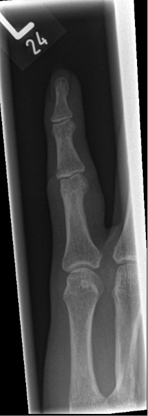 Röntgen Finger D5 links nach Reposition