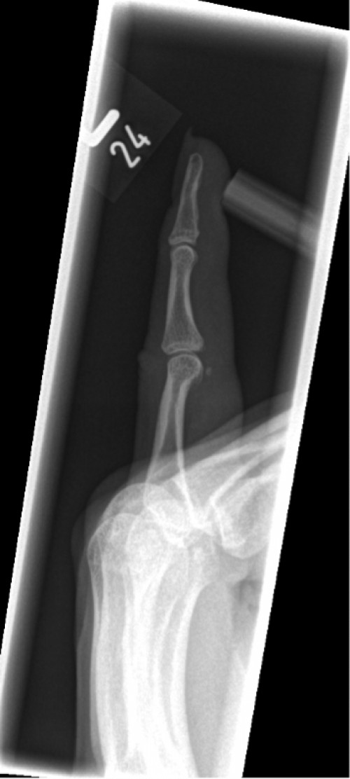 Röntgen Finger D5 links nach Reposition