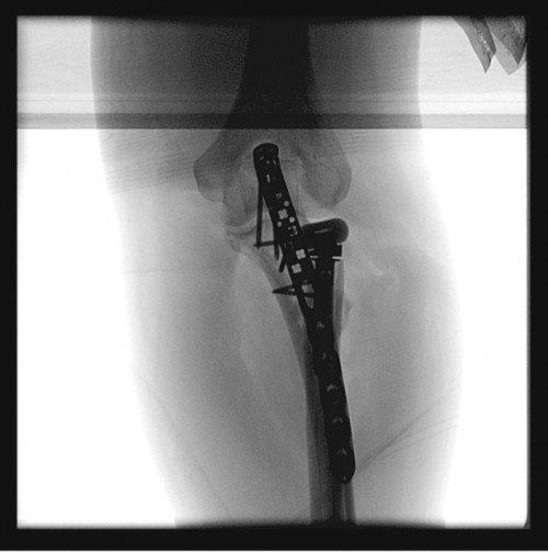 Intraoperative Durchleuchtung